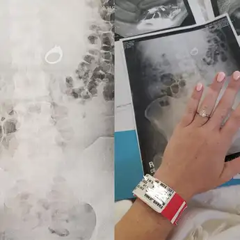 Gara-Gara Mimpi, Wanita 29 Tahun Ini Telan Cincin Tunangannya Sampai Harus Operasi