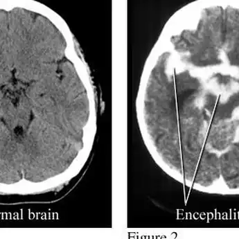 Alfin Meninggal Karena Encephalitis, Kenali Penyebab dan Risikonya