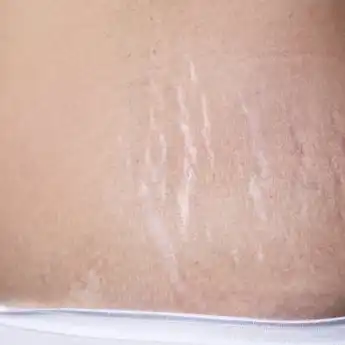 Punya Stretch Mark? Ikuti 5 Cara Alami Ini untuk Menyemarkannya