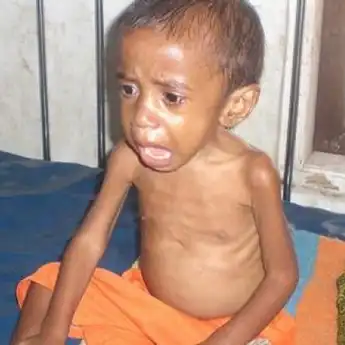 Terjawab Ini Sebab Angka Gizi Buruk dan Stunting di Tangerang Tinggi