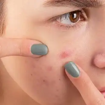 8 Arti Posisi Jerawat pada Wajah Berdasarkan Masalah Kesehatannya! Jerawat di Kening Berarti Masalah di Perut!