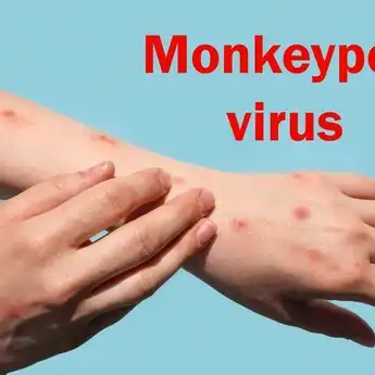 Bukan Cacar Monyet, Remaja Singkawang Ternyata Terkena Cacar Air