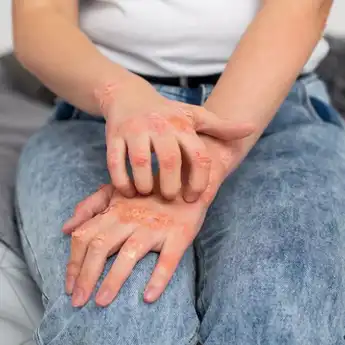 Dijamin Ampuh! Lakukan Cara Ini untuk Hilangkan Gatal Akibat Bekas Luka