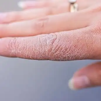 Alami Tangan Kering ? Begini Cara Mudah Mengatasinya