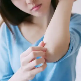 Jangan Digaruk! Ini Pertolongan Pertama Ketika Digigit Serangga