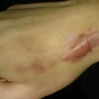 3 Obat Keloid yang Ampuh Mengempiskan, Bisa Dibeli Di Apotek