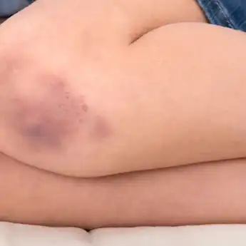 7 Penyebab Memar Biru Pada Kulit Secara Tiba-tiba, Bukan Dijilat Setan!