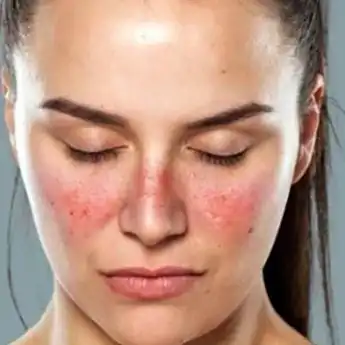 Memaknai Hari Lupus Sedunia serta Mengenal Penyakit Lupus