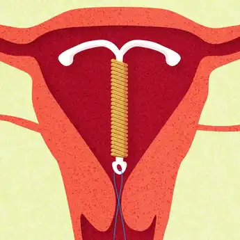 3 Efek KB IUD bagi Suami dan Cara Mencegahnya dengan Efektif