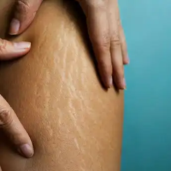 Penyebab Stretch Mark di Paha dan Cara Menghilangkannya