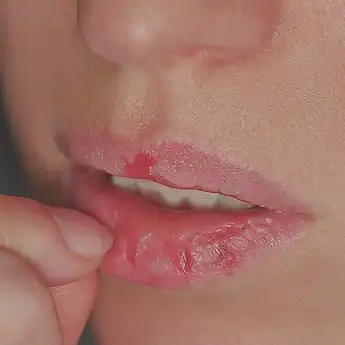 7 Cara Mengatasi Bibir Kering dan Mengelupas, Minum Air sampai Madu