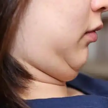 Punya Dagu Berlipat Bikin Nggak Pede, Begini Cara Menghilangkannya