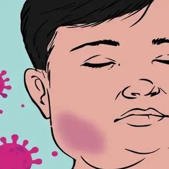 Penyakit Gondongan: Pengertian, Ciri-cirinya dan Cara Penyembuhannya