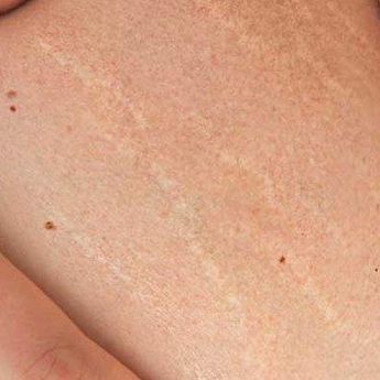 Benarkah Menggaruk Kulit Saat Menstruasi Picu Stretch Mark ?