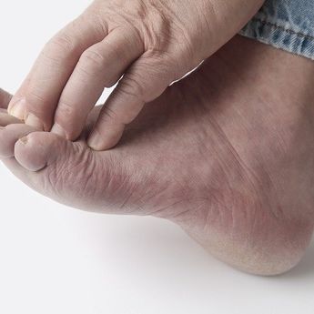 4 Cara Menghilangkan Kutu Air Dengan  Obat Dan Secara Alami 
