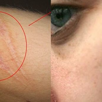 Bekas Luka Bisa Hilang Dengan 5 Bahan Alami Berikut Ini. Apa Sajakah ?