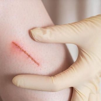 Manfaat Madu, Ini 8 Cara Menghilangkan Bekas Luka Dengan Bahan Alami!