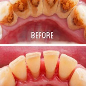 Bertahun-tahun Punya Karang Gigi Bikin Bau Mulut, Padahal Karang Gigi Bisa Rontok Sendiri Cuma Pakai Tanaman Ini