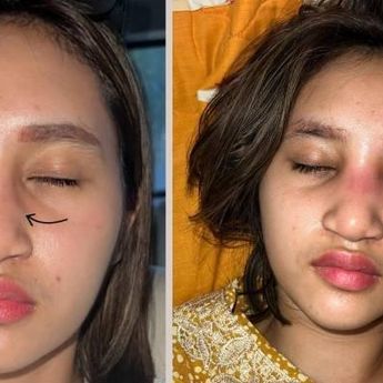 Operasi Plastik di Thailand karena Bosan Punya Hidung Pesek, Hidung Anak Farida Nurhan Malah Bengkak! Ternyata Ini Penyebabnya