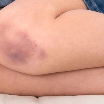 7 Penyebab Memar Biru Pada Kulit Secara Tiba-tiba, Bukan Dijilat Setan!