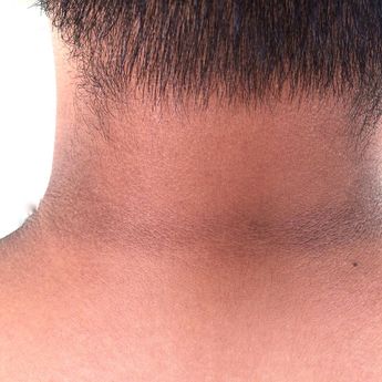 Auto Kinclong! Cara Menghilangkan Daki di Leher Pakai 6 Skincare Ini