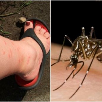 Yuk Hilangkan Bekas Gigitan Nyamuk dengan Tanaman Hias Ini