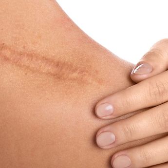 Cuma Dengan Bahan Ini, Bekas Luka Menjadi Keloid Bisa Hilang!