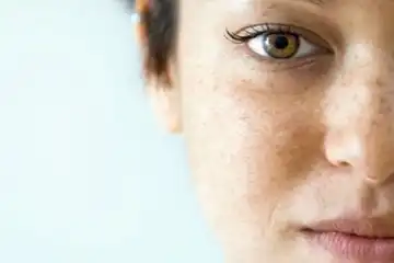 5 Cara Menghilangkan Flek Hitam di Wajah Dengan Mengunakan Bahan Alami