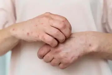 Meski terkesan sepele, hindari melakukan beberapa hal ini supaya  tak tertular cacar monyet.