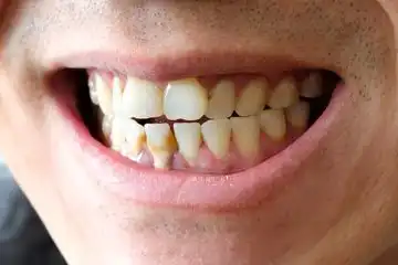 Ilustrasi gigi kuning
