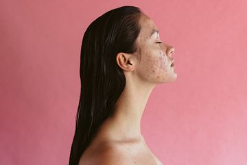 Ladies, Catat! Ini 10 Cara Menghilangkan Bruntusan di Jidat, Yakin ...