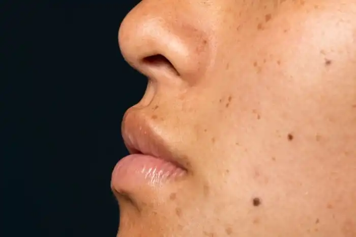 10 Cara Menghilangkan Bintik Hitam di Wajah seperti Tahi Lalat - Sonora.id