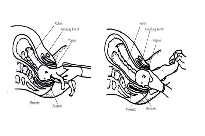 4 Cara Mengatasi Bayi Sungsang Lengkap dengan Faktor Penyebabnya