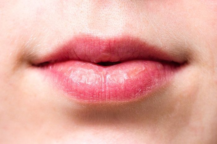Hati-hati Bibir Sering Pecah-Pecah dan Tak Sehat Bisa Jadi Tanda Gejala Penyakit Serius