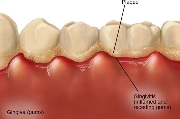 3 Cara Menghilangkan Plak Gigi Yang Menguning Secara Alami - Sonora.id