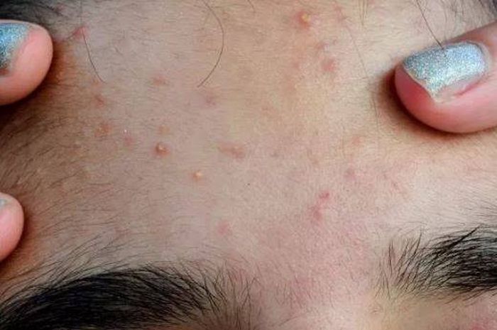 Dijamin Ampuh 5 Cara Cepat Hilangkan Jerawat Bruntusan Di Dahi Sonora Id