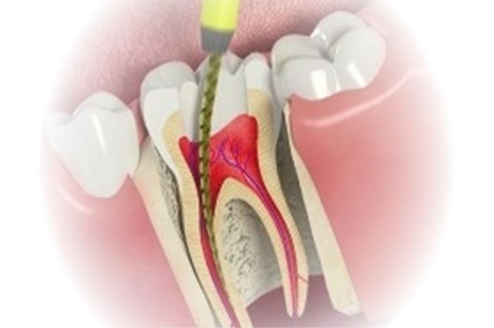 Kenapa Perawatan Saluran Akar Gigi Bikin Ngilu - Homecare24