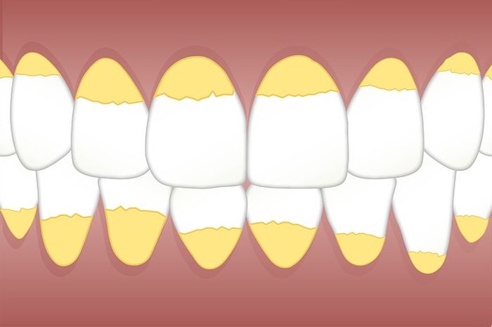 Ilustrasi karang gigi