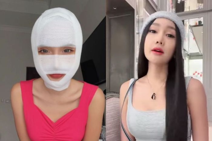 Kabar Duka! Operasi Jakun Lucinta Luna Tidak Selalu Berhasil, Ini Risikonya...