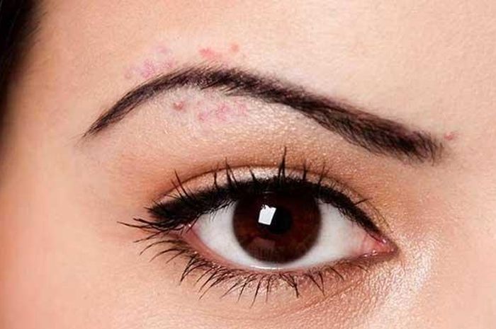 Jerawat di Area Alis Bikin Risih, Lakukan Tiga Cara Efektif ini Untuk