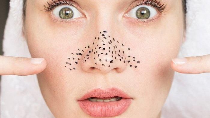 Ilustrasi komedo di hidung