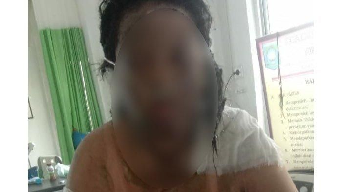 Kondisi luka bakar yang diderita AM (27), seorang istri di Desa Perlang, Lubuk Besar yang dibakar suaminya sendiri, Sabtu (7/5/2022) pagi