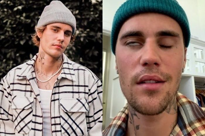 Bisa Sembuh Total, Ini Langkah-Langkah Pengobatan Sindrom Ramsay Hunt ...