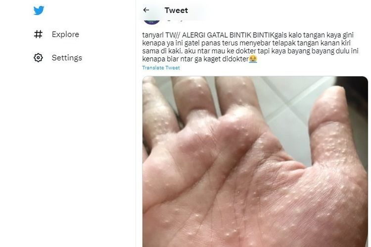 Ramai Soal Bintik Bintik Pada Telapak Tangan Yang Terasa Gatal Dan