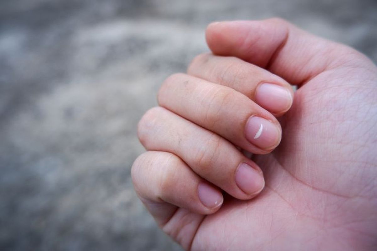 Bintik Putih di Kuku Menunjukkan Masalah Kesehatan(shutterstock)  