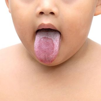Cara Membersihkan Lidah Bayi yang Putih dan Tebal