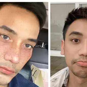 Selain Bubah Alfian, 5 Artis Indonesia Ini Akui Lakukan Operasi Plastik
