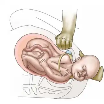 Demi Hindari Kematian, Dokter Harus Patahkan Tulang Sendi Bahu Bayi Saat Kondisi Ini